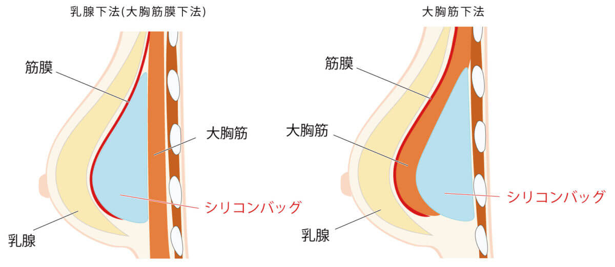 シリコンバッグ 人工乳腺 豊胸 大阪 バストアップ