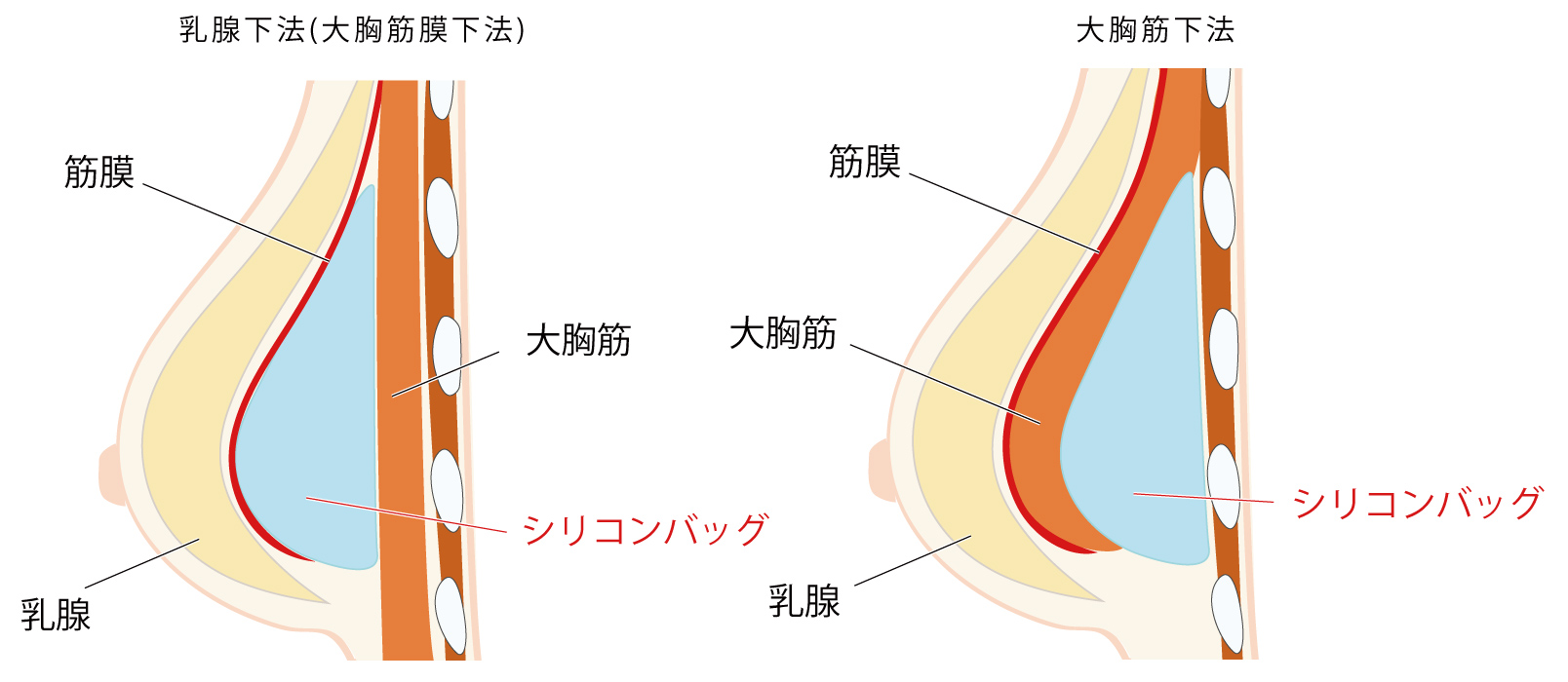 シリコンバッグ 人工乳腺 豊胸 大阪 バストアップ