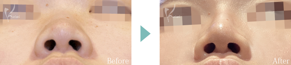 鼻尖形成+隆鼻術(プロテーゼ)の症例写真