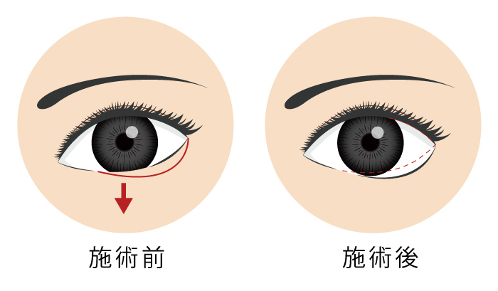 下眼瞼下制術　グラマラスライン タレ目形成 イメージ画像