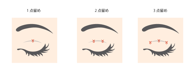 二重 整形 MT 埋没法 プチ整形