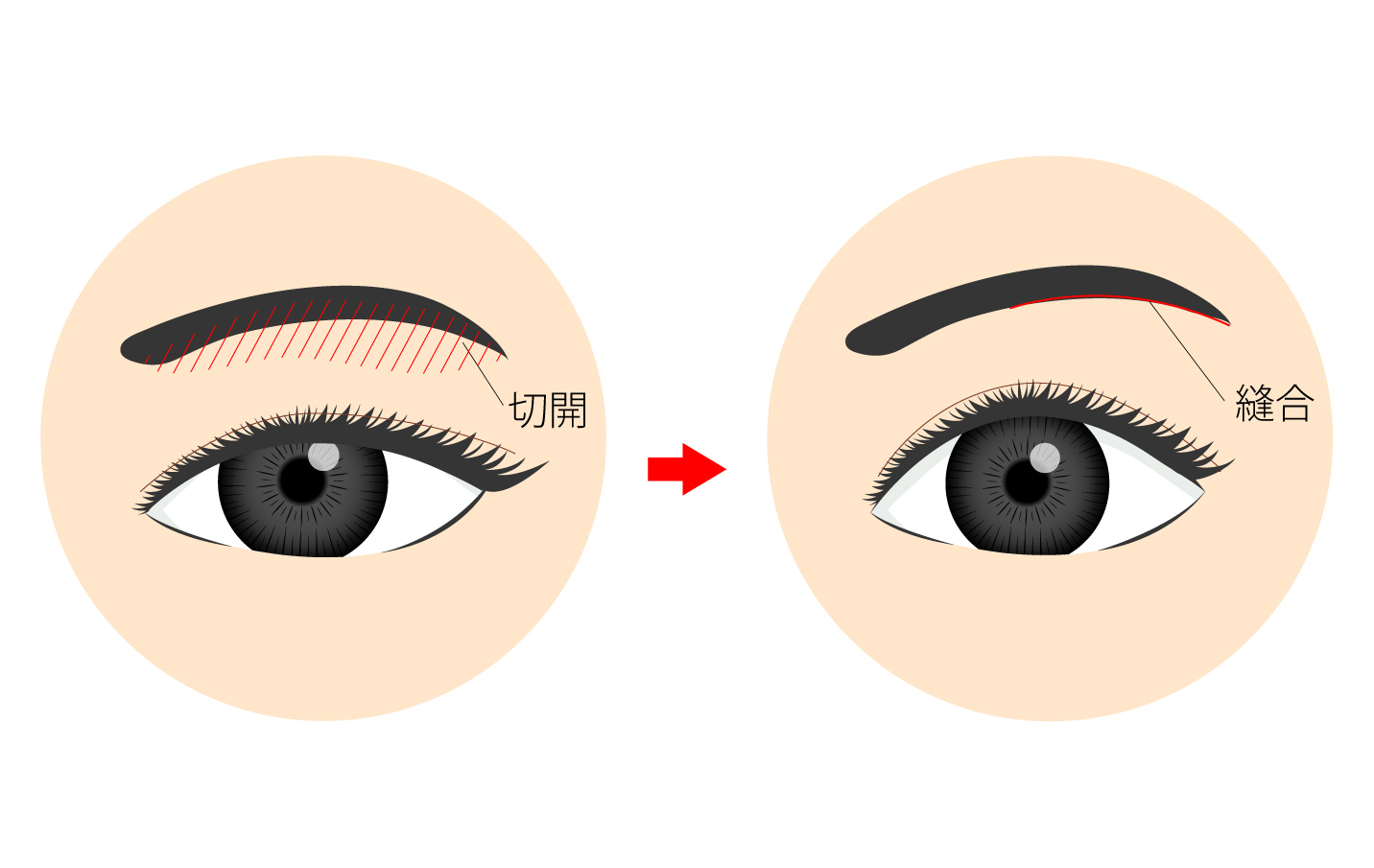 眉下切開術の説明図