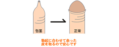 包茎 ほうけい かんとん 男性器 大阪 泌尿器形成