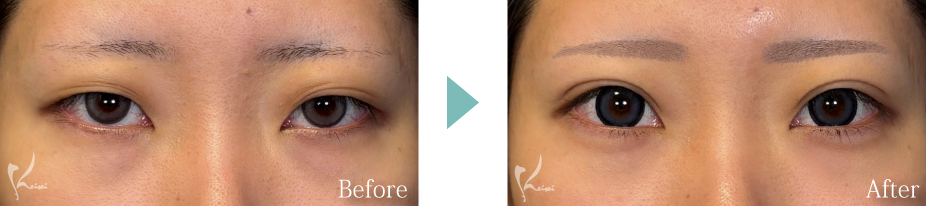 MT埋没法＋涙袋形成　症例写真