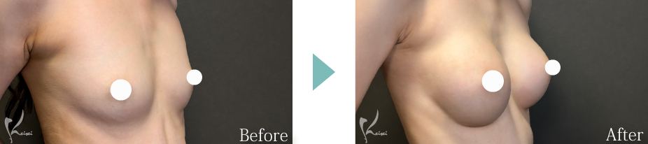 シリコンバッグ豊胸症例