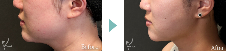 ホホとアゴの脂肪吸引 症例写真