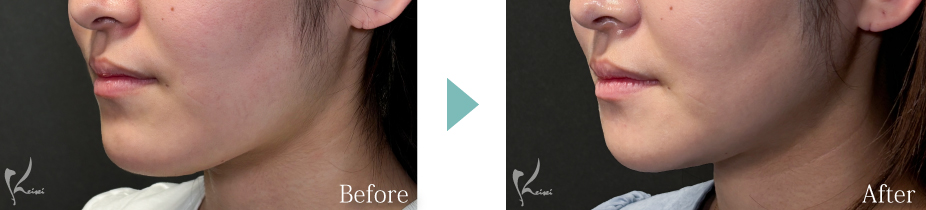 Vライン形成（エラ+顎）：エラの骨切り（下顎角形成）とアゴ（オトガイ形成）症例写真