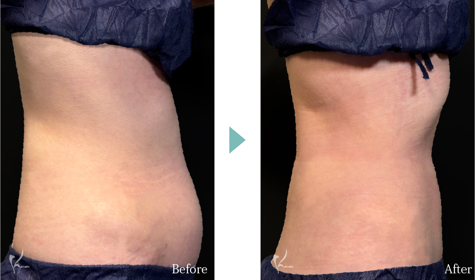 腹部全体+腰 ボディジェット脂肪吸引の症例写真