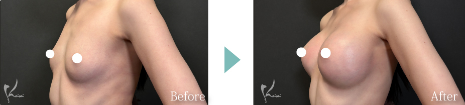 シリコンバッグ豊胸の症例写真