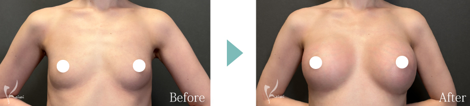 シリコンバッグ豊胸の症例写真