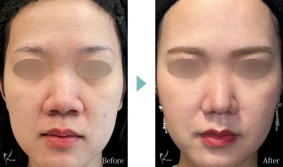 鼻中隔延長（耳介軟骨移植）＋鼻尖形成＋小鼻縮小（鼻翼縮小）の症例写真