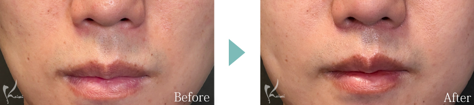 人中短縮術（リップリフト）症例写真