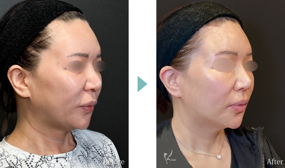トータルフェイスリフト（ロアーリフト＋ネックリフト）の症例写真