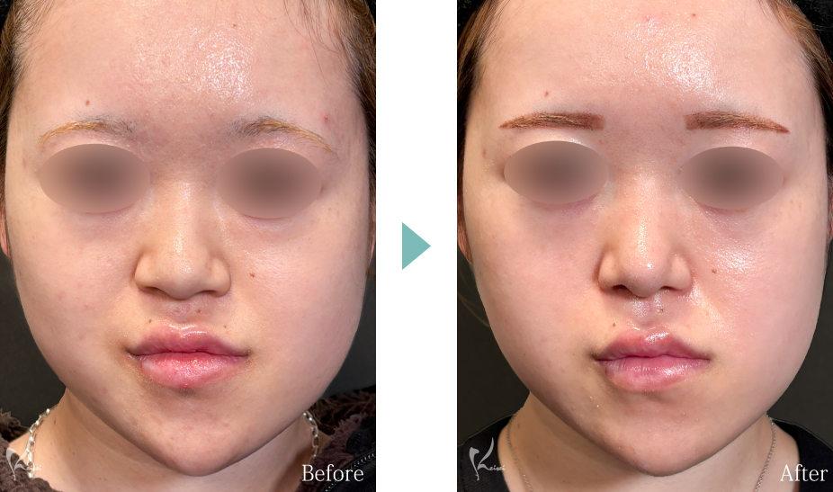 小鼻縮小（鼻翼縮小）＋鼻尖形成＋鼻中隔延長（耳介軟骨移植）の症例写真