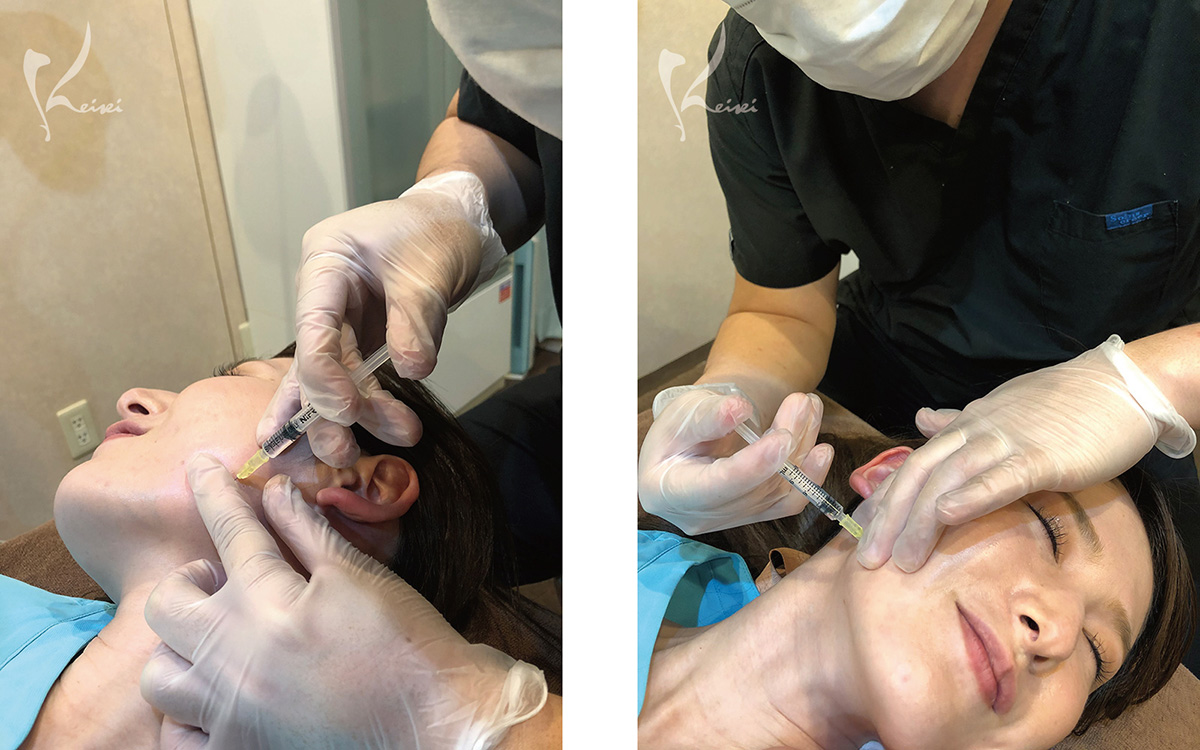 エラボトックス　小顔効果と歯ぎしりの改善
