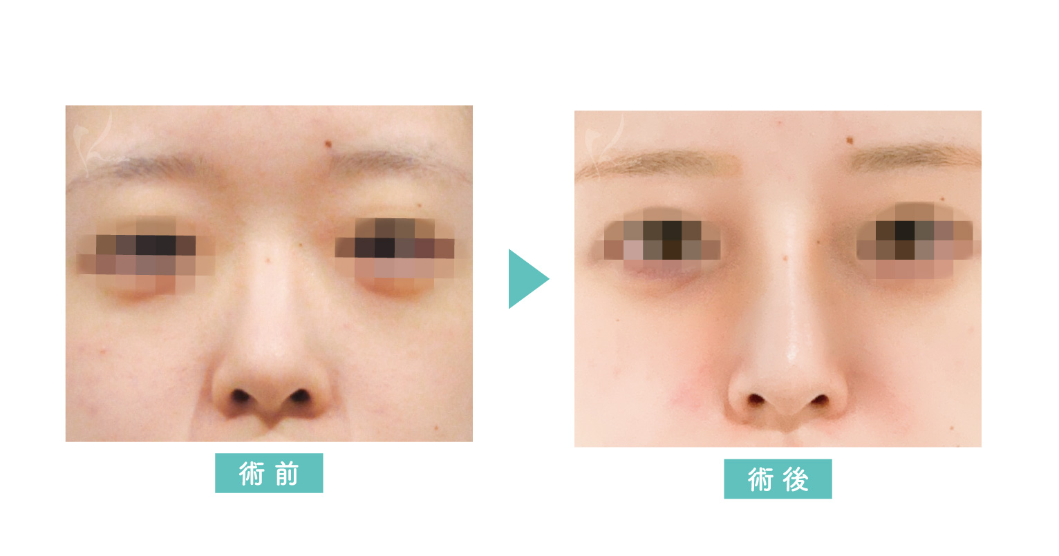 鼻プロテーゼ症例写真(正面)
