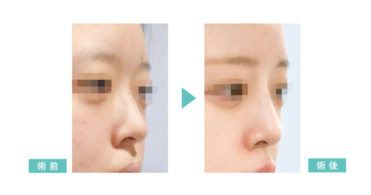鼻プロテーゼ症例写真（斜め）