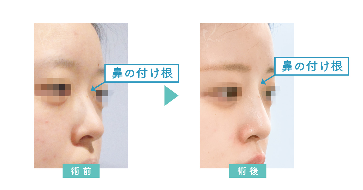 鼻プロテーゼ症例写真(斜め)
