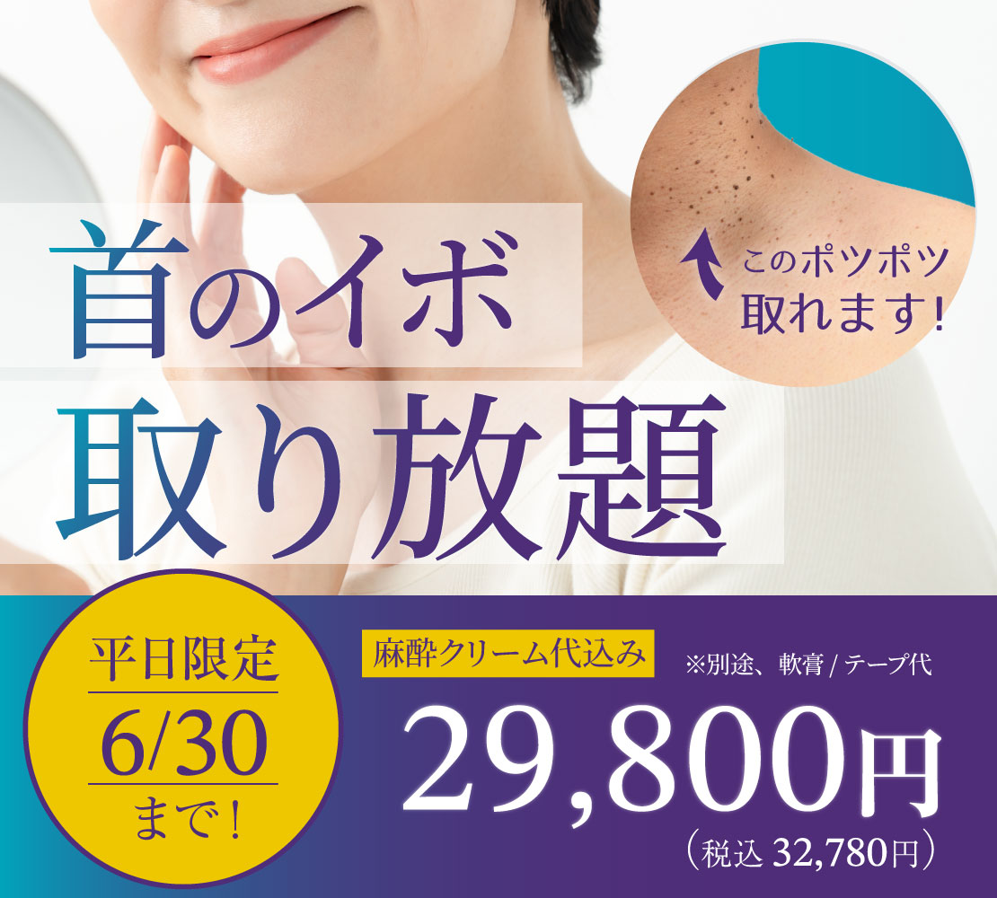 キャンペーン首のイボ 取り放題バナー
