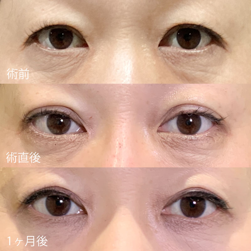 小西医師の埋没症例