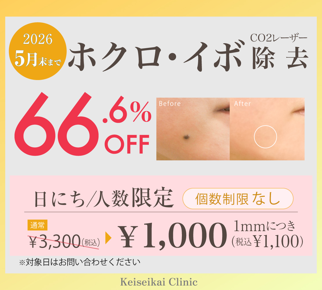 ホクロ・イボ除去キャンペーンバナー