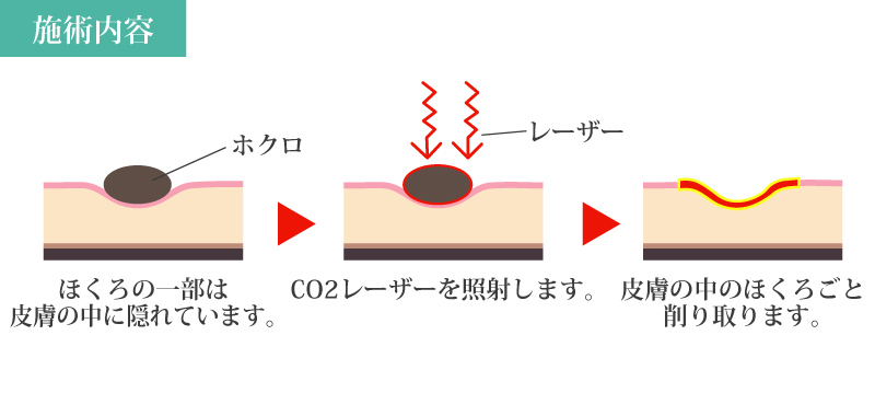 ホクロ除去 ホクロ取り CO2レーザー 流れ