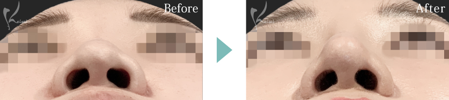 鼻尖形成+隆鼻術(プロテーゼ)+小鼻縮小(中間法)+鼻中隔延長(耳介軟骨移植)の症例写真