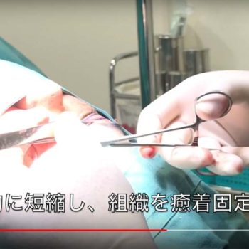 保険適用治療でぱっちり二重「眼瞼下垂」を動画でご紹介します。