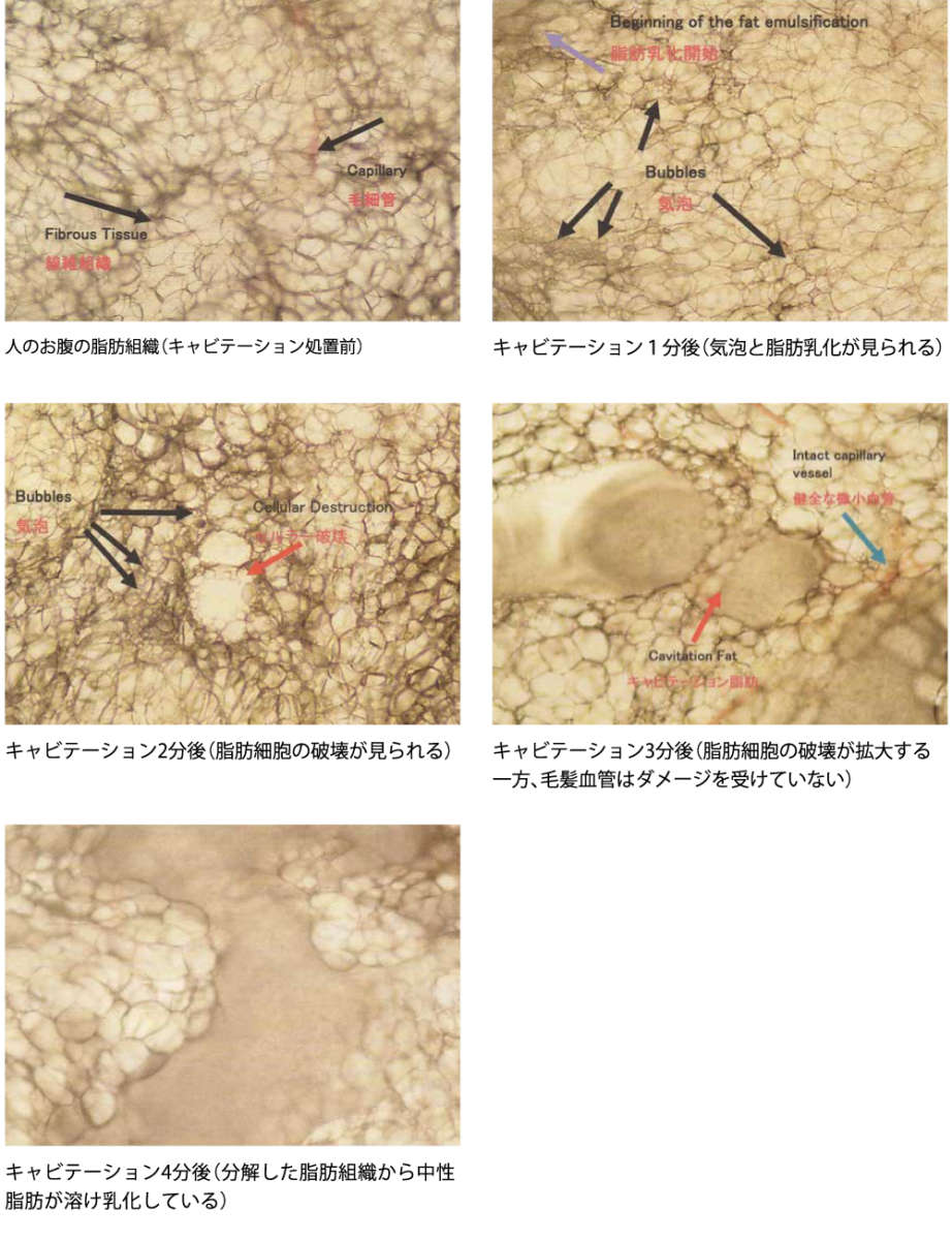 気になる身体の部分痩せに キャビテーションシェイプ｜恵聖会