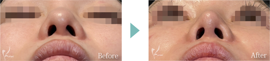 鼻尖形成+隆鼻術(プロテーゼ)+鼻中隔延長(耳介軟骨移植)の症例写真