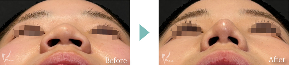 小鼻縮小(鼻翼縮小)+鼻尖形成+鼻中隔延長(耳介軟骨移植)の症例写真