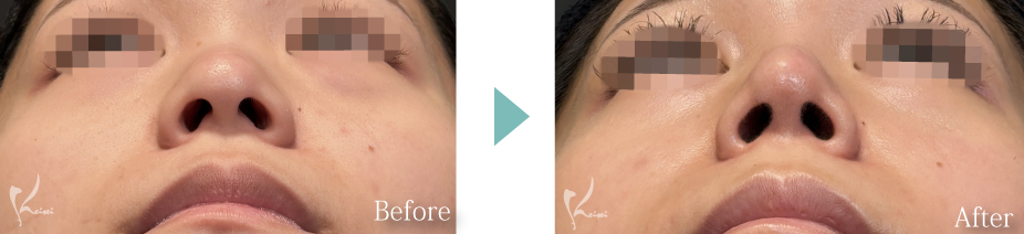 鼻尖形成+隆鼻術(プロテーゼ)+鼻中隔延長(耳介軟骨移植)の症例写真