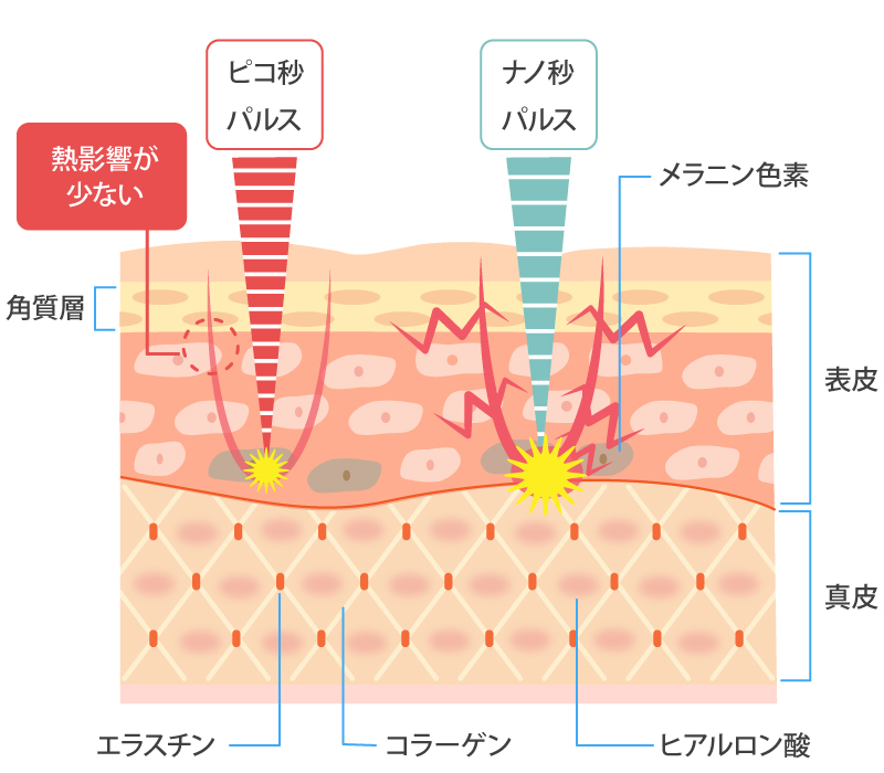 ピコトーニング