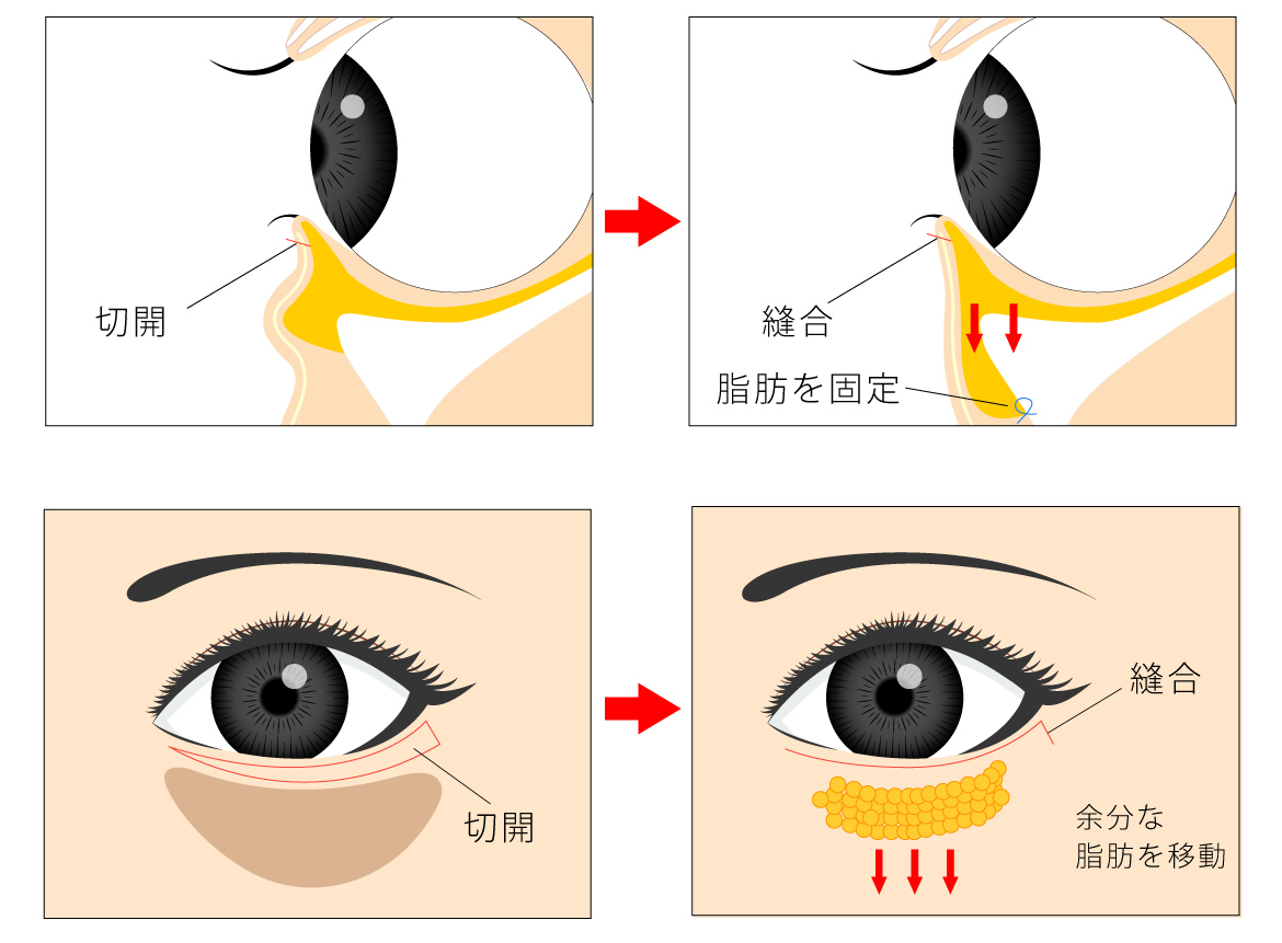 下眼瞼たるみ取り 目元のたるみ ハムラ法 エイジングケア アンチエイジング 下まぶた