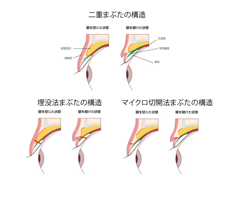 二重整形 マイクロ切開 ミニ切開 部分切開 大阪