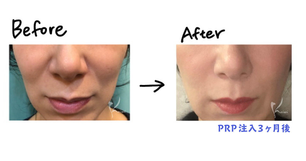 ほうれい線との戦い 恵聖会クリニック 大阪の美容外科 美容皮膚科