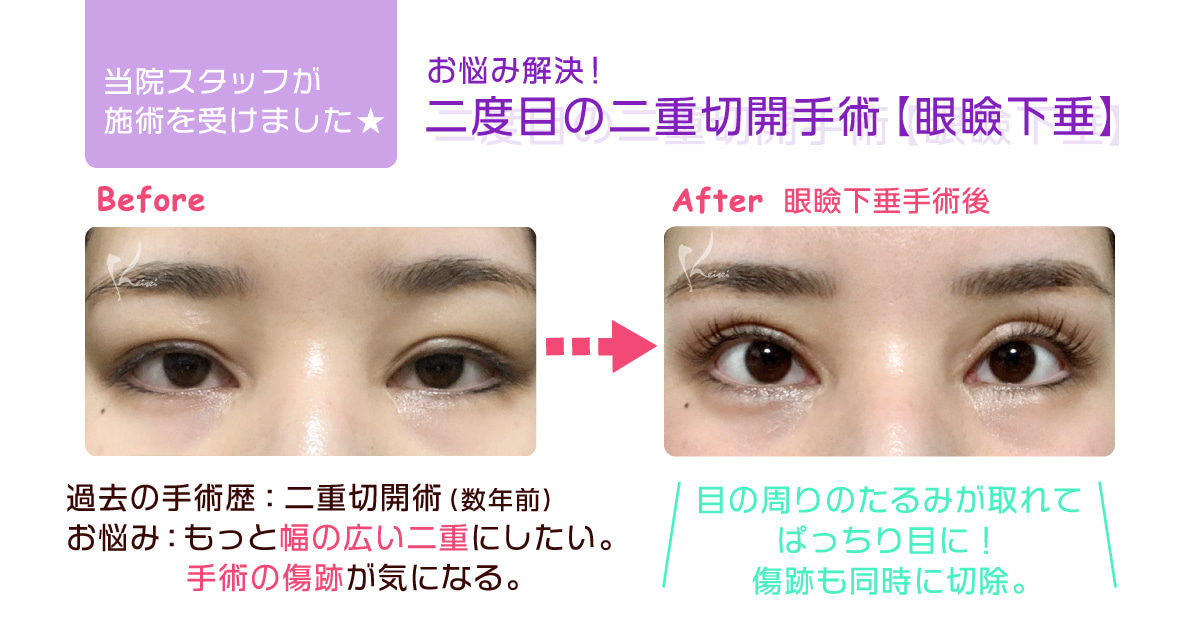 二重切開修正 眼瞼下垂 恵聖会クリニック 大阪の美容外科 美容皮膚科 二重切開修正 眼瞼下垂 恵聖会クリニック 大阪の美容外科 美容皮膚科