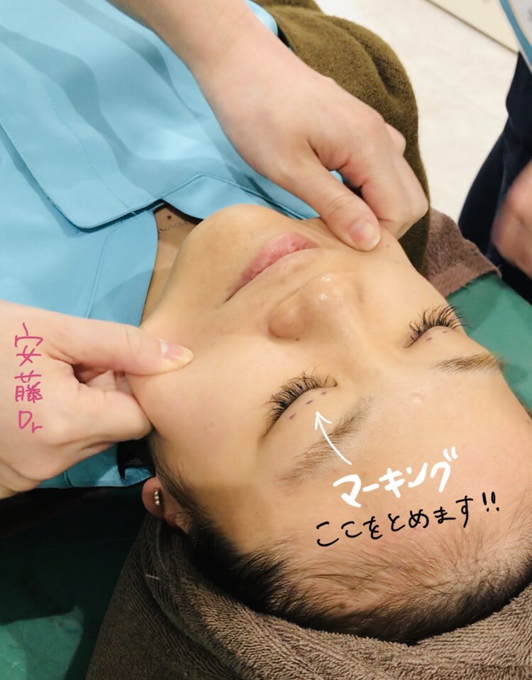 松本医師 埋没法 手術前 マーキング