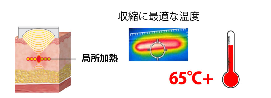 ドット（点状）照射のイメージ図