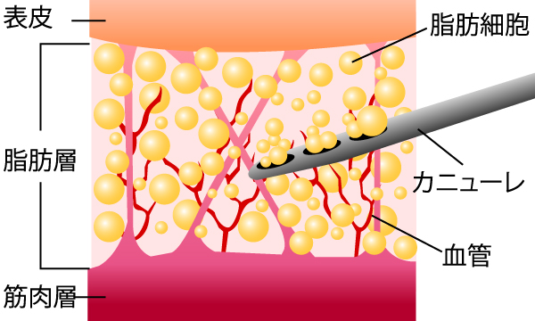 脂肪吸引の仕組み