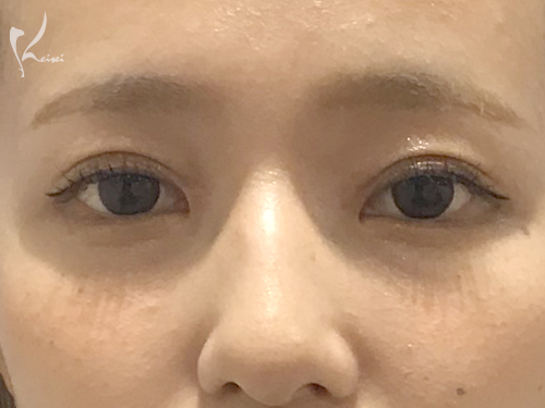 二重埋没法(MT埋没法3点留め)+目頭切開術(術後1ヶ月)