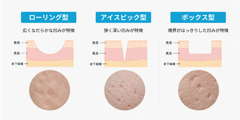 クレーターの種類（ローリング型、アイスピック型、ボックス型）