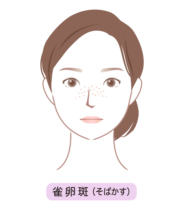 そばかすイメージ