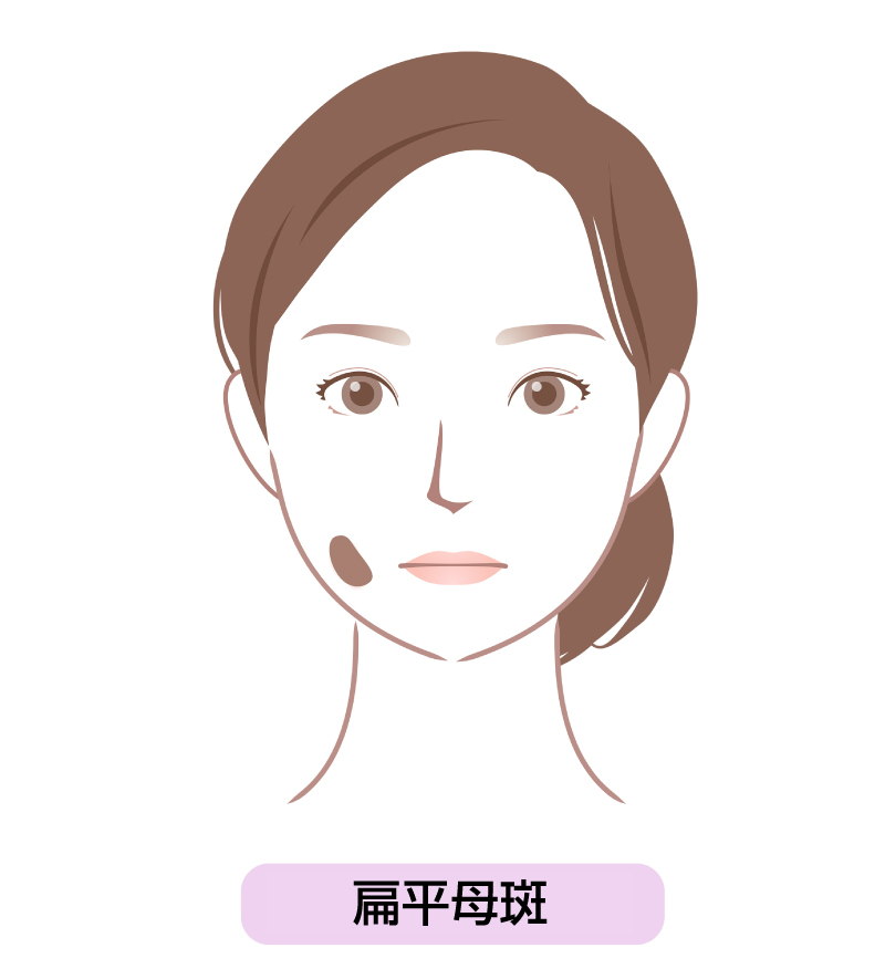 扁平母斑イメージ