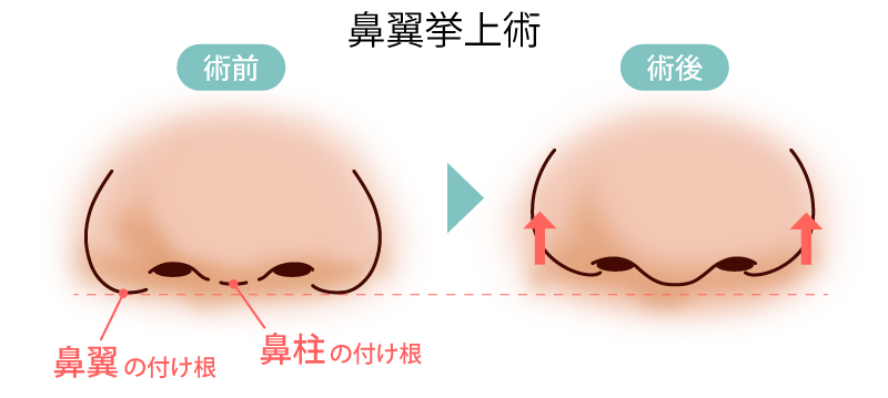 鼻翼挙上術