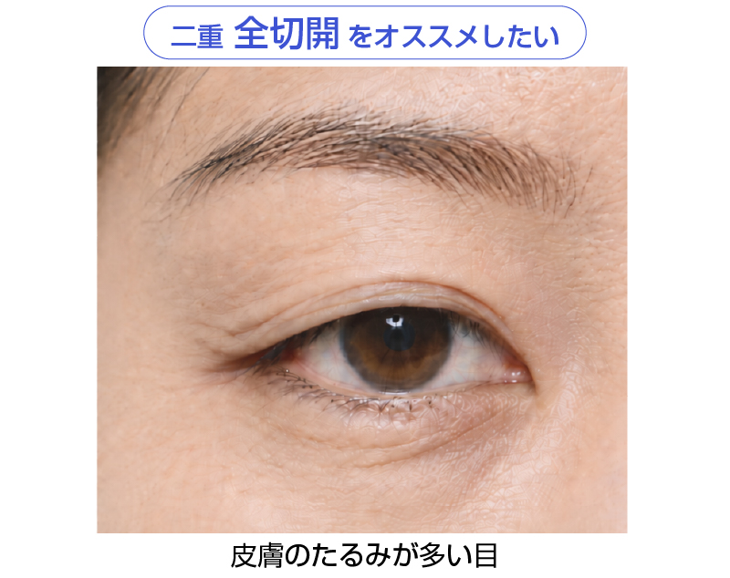 皮膚のたるみが多い目