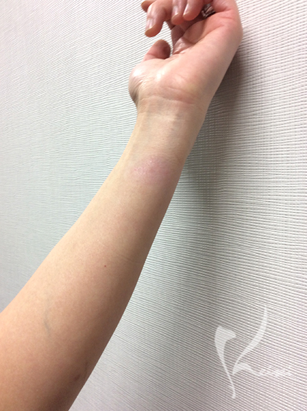 火傷から4ヶ月後