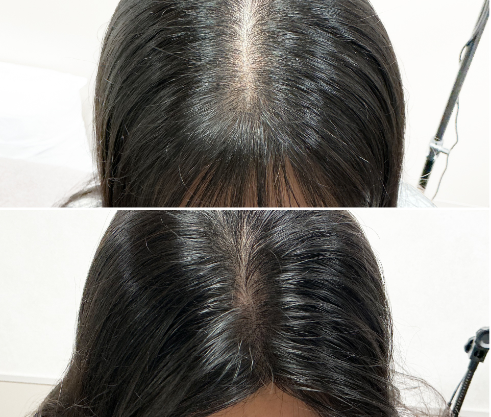 ヘアアートメイク生え際・分け目の症例写真