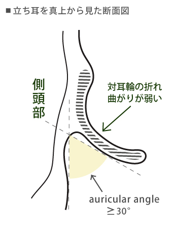 対耳輪の折れ曲がりが弱い立ち耳の断面図