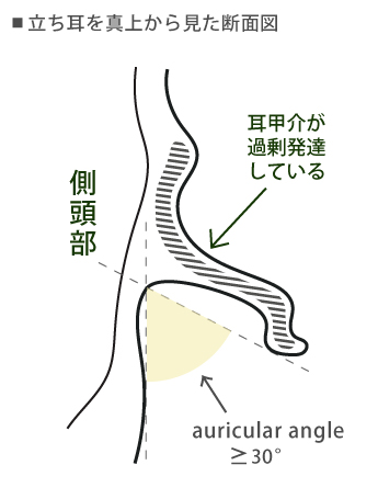 耳甲介が過剰発達した立ち耳の断面図